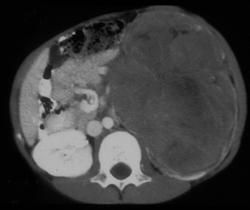 Wilms Tumor - CTisus CT Scan