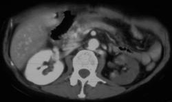 Global Renal Infarction - CTisus CT Scan