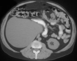 Ureteropelvic Junction (UPJ) With Sac for Right Kidney - CTisus CT Scan