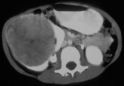 Renal Cell Carcinoma - CTisus CT Scan