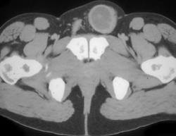 Tumor of Spermatic Cord - CTisus CT Scan