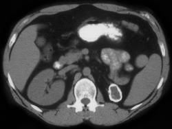 Tuberculosis (TB) -end Stage Left Kidney - CTisus CT Scan