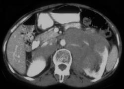 Lymphoma Invades Kidney - CTisus CT Scan