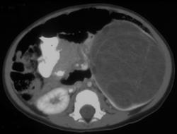 Wilms Tumor - CTisus CT Scan