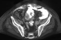 Bladder Perforation With Intraperitoneal Spread - CTisus CT Scan