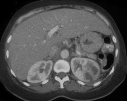 Acute Pyelonephritis - CTisus CT Scan