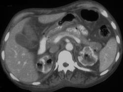 Air in Collecting Systems - CTisus CT Scan