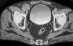 Undescended Testicle on Right - CTisus CT Scan