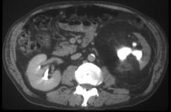 Xanthogranulomatous Infection Left Kidney - CTisus CT Scan