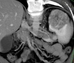 Renal Cell Carcinoma Involves Left Renal Vein - CTisus CT Scan