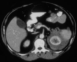 Perirenal Infiltration By Non-Hodgkin Lymphoma - CTisus CT Scan