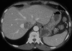 Renal Cell Carcinoma Invades the Inferior Vena Cava (IVC) - CTisus CT Scan