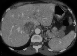 IVC Clot From Renal Cell Carcinoma - CTisus CT Scan