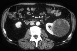 Renal Cell Carcinoma - CTisus CT Scan