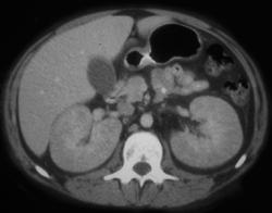 Lupus Nephritis - CTisus CT Scan