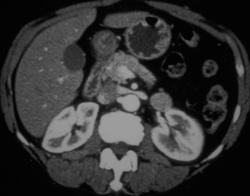 1 Cm Renal Cell Carcinoma - CTisus CT Scan