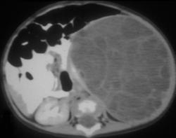 Cystic Wilms Tumor - CTisus CT Scan