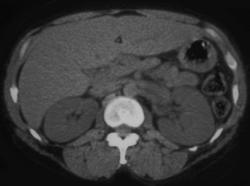 Acute Left Pyelonephritis - CTisus CT Scan