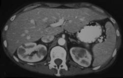 Renal Metastases - CTisus CT Scan