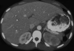 Acute Pyelonephritis - CTisus CT Scan