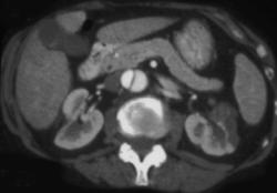 Aortic Dissection With Segmental Left Renal Infarction - CTisus CT Scan