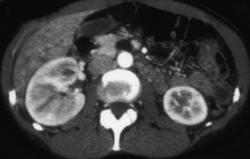 Acute Pyelonephritis Better Seen on Late Phase Imaging - CTisus CT Scan