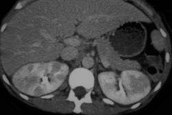 Acute Pyelonephritis Bilaterally - CTisus CT Scan