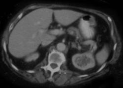 Transitional Cell Carcinoma - CTisus CT Scan