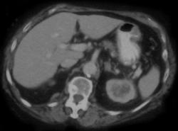 Transitional Cell Carcinoma- Left Kidney - CTisus CT Scan