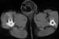 Bowel Herniates Into Scrotum - CTisus CT Scan