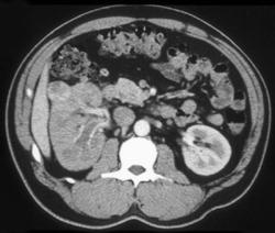 Infiltrating Renal Cell Carcinoma of the Right Kidney - CTisus CT Scan