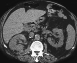 Pseudoaneurysm Right Kidney S/P Partial Nephrectomy - CTisus CT Scan