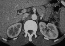 Acute Pyelonephritis - CTisus CT Scan