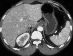 Acute Pyelonephritis - CTisus CT Scan