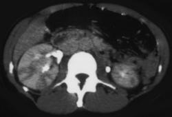 Acute Pyelonephritis - CTisus CT Scan