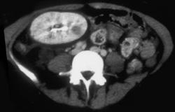 Acute Pyelonephritis With Abscess in A Transplanted Kidney - CTisus CT Scan