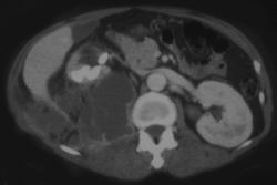 Xanthogranulomatous Pyelonephritis (XGP) With Psoas Abscess - CTisus CT Scan