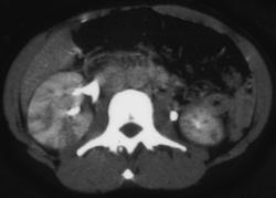 Acute Pyelonephritis - CTisus CT Scan