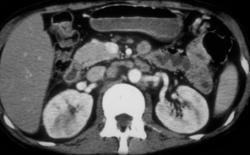 Acute Pyelonephritis - CTisus CT Scan