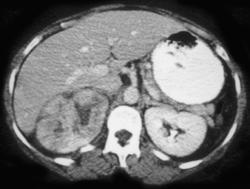 Acute Pyelonephritis - CTisus CT Scan