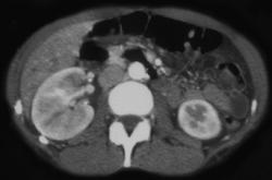 Acute Pyelonephritis - CTisus CT Scan