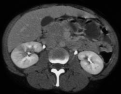 Acute Pyelonephritis - CTisus CT Scan