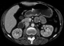 Acute Pyelonephritis - CTisus CT Scan