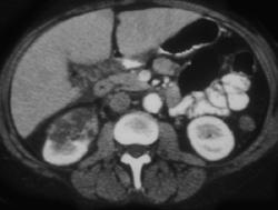 Segmental Renal Infarct - CTisus CT Scan