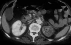 2 Cases of Renal Infarction - CTisus CT Scan