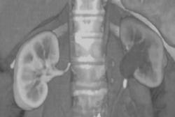 Obstructing Stone in Left Proximal Ureter - CTisus CT Scan