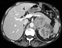 Infiltrating Renal Cell Carcinoma With Bulky Nodes - CTisus CT Scan