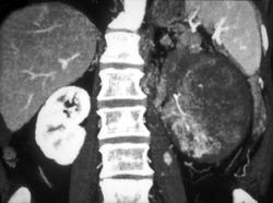 3D of Infiltrating Renal Cell Carcinoma - CTisus CT Scan