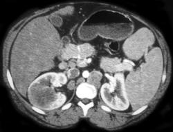 Renal Carcinoma With Adenopathy - CTisus CT Scan