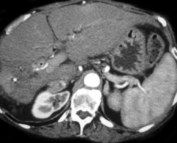 Radiation Changes in Right Kidney in Patient With History of Cholangiocarcinoma - CTisus CT Scan